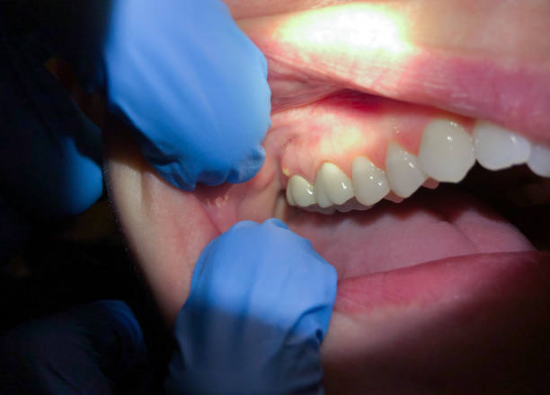 Best Chipped Tooth Repair Near Me  in Clintonville, WI